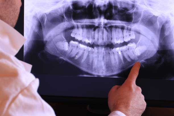 Best Emergency Wisdom Teeth Removal in Monument Hills, CA